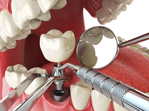 Best Emergency Tooth Extraction in Orangeburg, NY